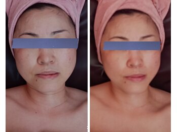 シャルマン(charmant)/グロッティプロ◆エクソソーム