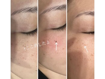 ラヴィエール(Laviere)/シミ緩和＋プラズマシャワー