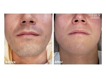 ユーフォリアプラス(euphoria +plus)/メンズ髭脱毛