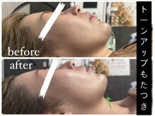 ビノスビューティー(vinos.beauty)/症例写真　小顔矯正/小倉エステ