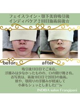 フランジパニ/【インディバ☆美容吸引後ケア】