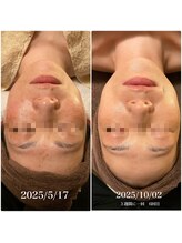 サボナティオ(Sabonatio)/陶肌トリートメント