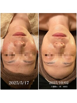 サボナティオ(Sabonatio)/陶肌トリートメント