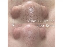 エステティック リベル キョウト 京都駅前店(Esthetic Liber Kyoto)/毛穴洗浄×ハーブピーリング