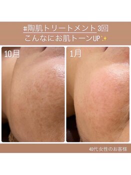 ハオン(HAON)の写真/痛み、皮剥け、ダウンタイム無しのハーブピーリングでシミしわ改善！肌を整え、くすみケア！理想の卵肌へ♪