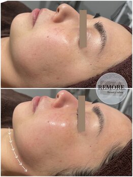 リモア(REMORE.)/シリカマイクロニードル