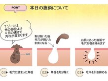 美プラス/毛穴洗浄