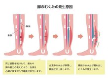 藤が丘名倉堂鍼灸接骨院/むくみとは