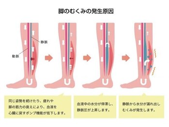 藤が丘名倉堂鍼灸接骨院/むくみとは