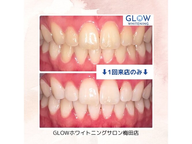 【歯科提携】GLOWホワイトニングサロン梅田店