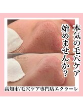 エクラーレ(Eclale)/【毛穴ケア】症例