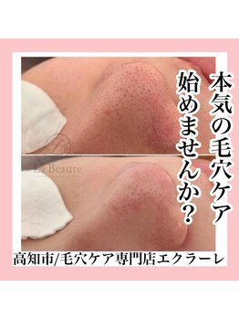 エクラーレ(Eclale)/【毛穴ケア】症例
