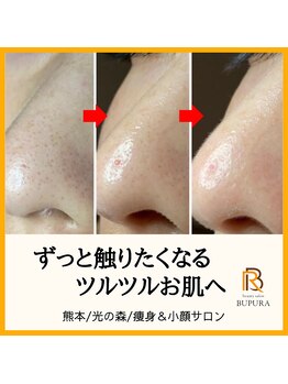 ブプラ 光の森店(BUPURA)/ビフォーアフター