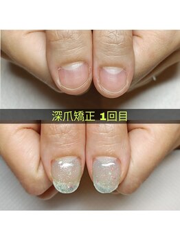 マニエネイル(mani e nail)/深爪矯正で夏の爪美人になろう♪