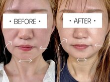 シャインアン(Shine'an)/たるみ改善美顔筋テラボーラー