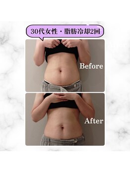 グランディールアン(GRANDIR UN)/脂肪冷却2回目から2週間後