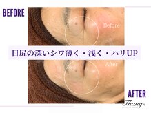 サンク(Thanq)/目尻のシワもふっくらハリUP