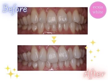 エクシアホワイトニング 天王寺店/ホワイトニングビフォーアフター