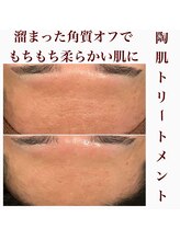 心斎橋 ルヴィ(REVI)/ハーブピーリング