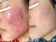エヌ(N)の写真/本気のハーブピーリングでお肌を根本改善！何をしても改善しなかったお悩みプロにお任せください◎