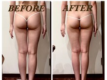 プリマ(Prima)/【2回施術】　BEFORE&AFTER