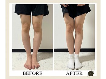 サンク(Cinq)/O脚・X脚を改善したい