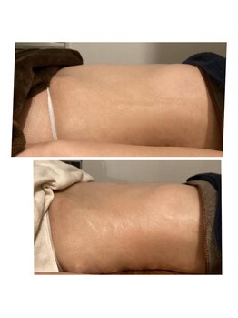 トータルエステティック ジョワイユ(JOYEUX)/お腹脂肪集中ケア