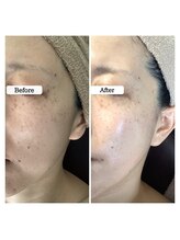 ル ボヌール 伊那店(le bonheur)/シミケア