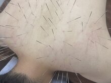 辛いお悩み笠岡で唯一のルート鍼ぜひ受けてください！