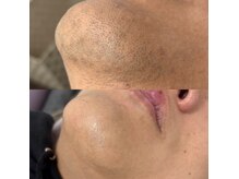 【経過写真】メンズも歓迎！濃いヒゲも着実に減っていきます☆