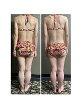 チュラ/ハイパーナイフ/所沢/痩身エステ