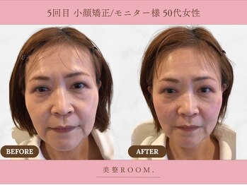 美整ルーム 横浜店(美整ROOM)/5回目施術