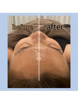 脱毛 フェイシャルサロン オットー(OTTO)/エアバリで小顔美白毛穴ケア！