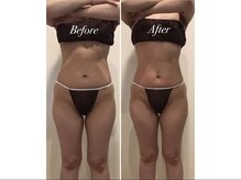 エステティックサロン フェアリー(ESTHETIC SALON FAIRLY)/痩身＊セルゼロBefore→After