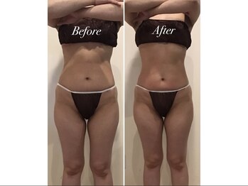 エステティックサロン フェアリー(ESTHETIC SALON FAIRLY)/痩身＊セルゼロBefore→After