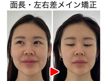エレヴィザ トウキョウ 恵比寿院(ELVISA TOKYO)/面長・左右差改善 / 初回施術