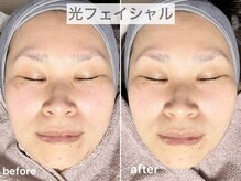 ブルーム(Bloom.)/光フェイシャル