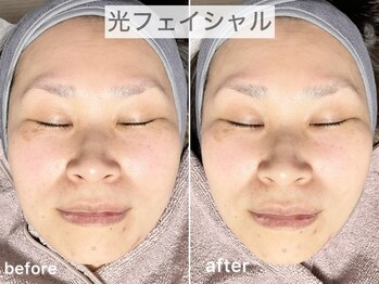 ブルーム(Bloom.)/光フェイシャル