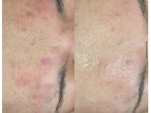 エヌエースキン 北谷店(NAskin)/ハーブピーリング｜ニキビケア