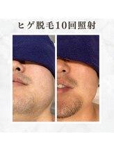 ボゴス(BOGOSS)/ヒゲ脱毛10回照射