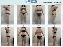 シュシュ(CHUCHU)の雰囲気（脂肪冷却100カップ）