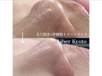 エステティック リベル キョウト 京都駅前店(Esthetic Liber Kyoto)/毛穴洗浄×ハーブピーリング