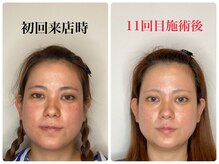 はりと美容鍼灸治療院(HaRi&美容鍼灸治療院)の雰囲気（美容鍼は継続して大事。続けることで効果も確実に見えてきます！）
