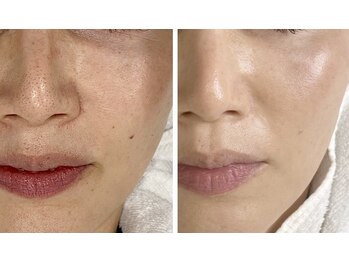 リラルボ(Relaluvo)の写真/肌を育てるスキンケアフェイシャルWAX★高濃度の美容成分で毛穴改善くすみハリ感アップの輝き体験しよう♪