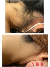 シースタイル(C-S.t.y.l.e.)/うなじ脱毛！