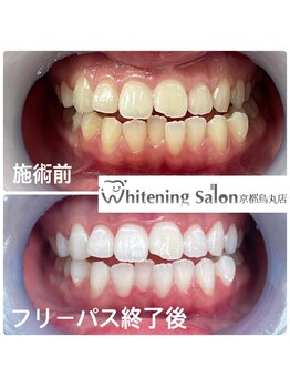 ホワイトニングサロン 京都烏丸店/ホワイトニング施術例