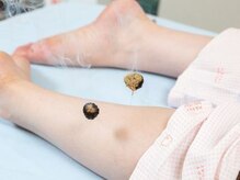 藤田はりきゅう治療院/お灸（きゅう）施術