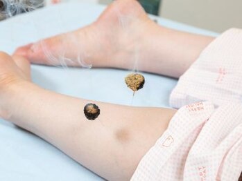 藤田はりきゅう治療院/お灸（きゅう）施術