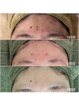 サロンドジェシカ(salon de Jessica)/ハーブピーリング