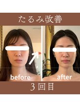 カムズ ビューティー(COMES BEAUTY)/たるみ改善小顔ケア3回目